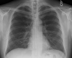 X-RAY PA  VIEW CHEST