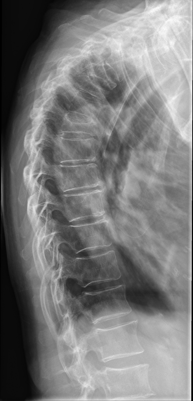 X-RAY LATERAL VIEW DORSAL SPINE