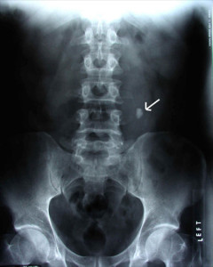 X-RAY  KUB