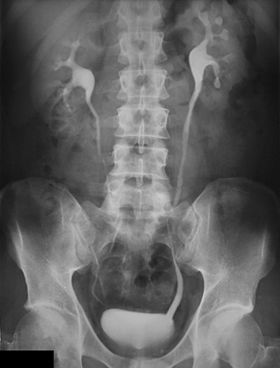 X-RAY FISTULOGRAM