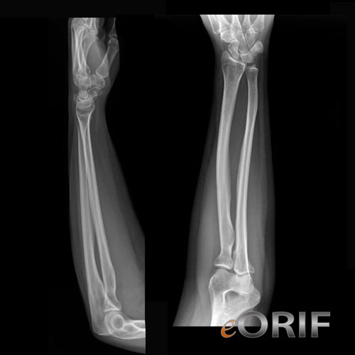 X-RAY LATERAL VIEW BOTH FOREARM