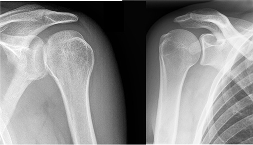 X-RAY AP/ LATERAL VIEW BOTH SHOULDER