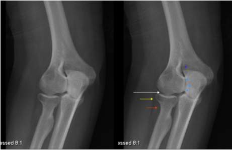 X-RAY AP VIEW BOTH ELBOW