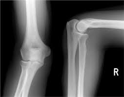 X-RAY AP/LATERAL VIEW ELBOW