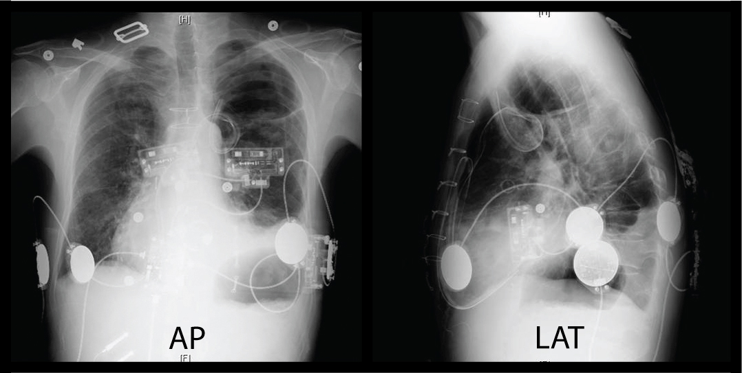 X-RAY AP/LATERAL VIEW CHEST