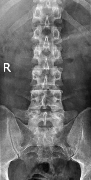 X-RAY AP VIEW LUMBAR SPINE