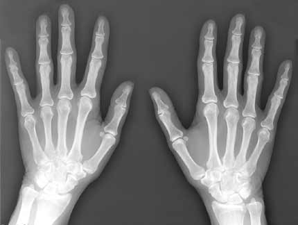 X-RAY AP VIEW BOTH HAND