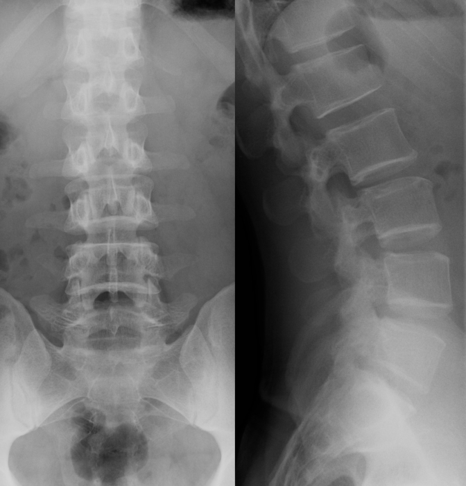 X-RAY AP/LATERAL VIEW LUMBAR SPINE