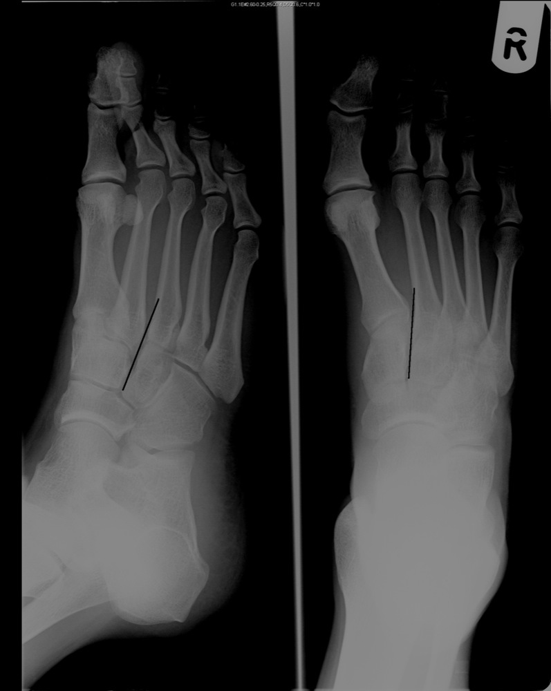 X-RAY AP/LATERAL VIEW FOOT (ONE)