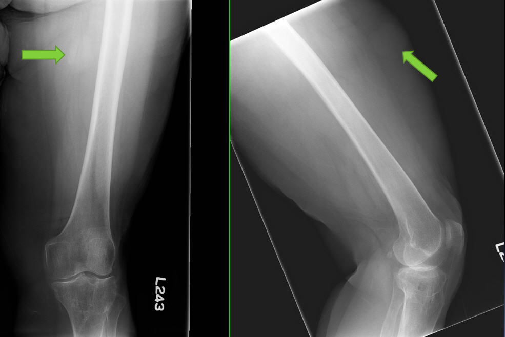 X-RAY AP/LATERAL VIEW THIGH (ONE)