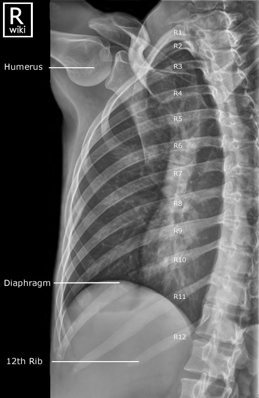 X-RAY OBLIQUE VIEW CHEST