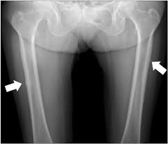 X-RAY AP/LATERAL VIEW BOTH THIGH