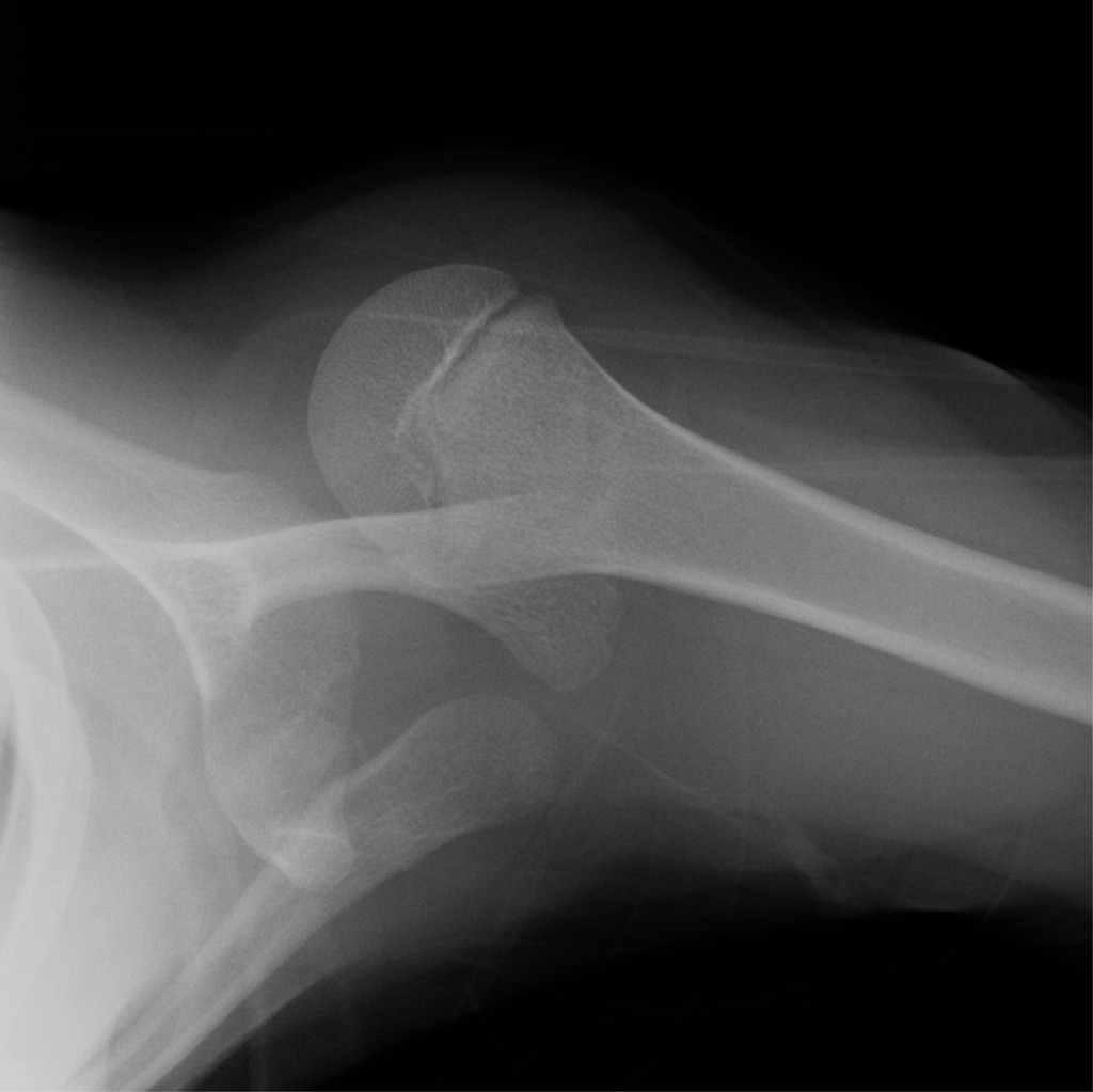 X-RAY LATERAL (OBLIQUE) VIEW SHOLDER