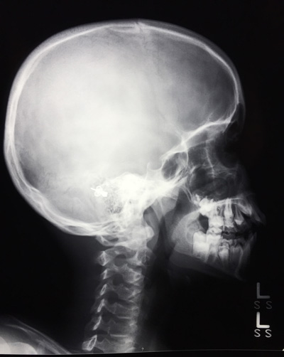 X-RAY LATERAL VIEW SKULL/ HEAD