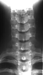 X-RAY AP VIEW CERVICAL SPINE