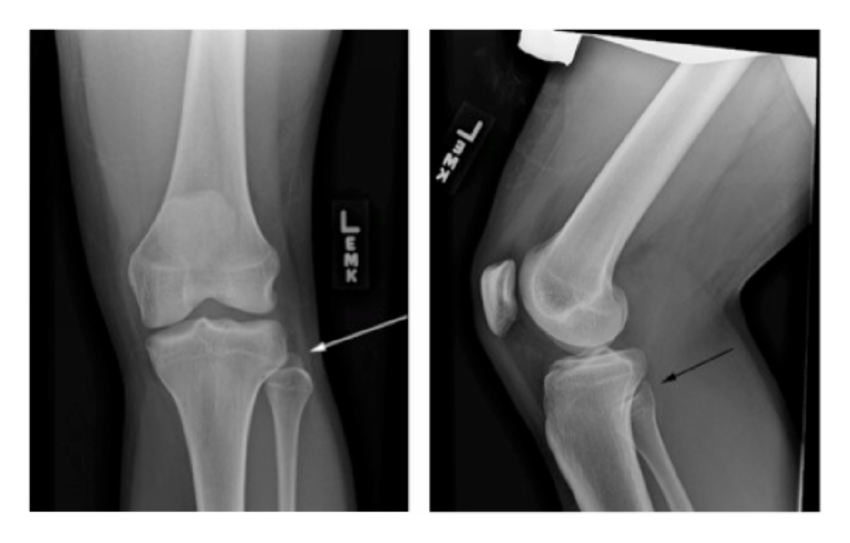 X-RAY AP/LATERAL VIEW (ONE)